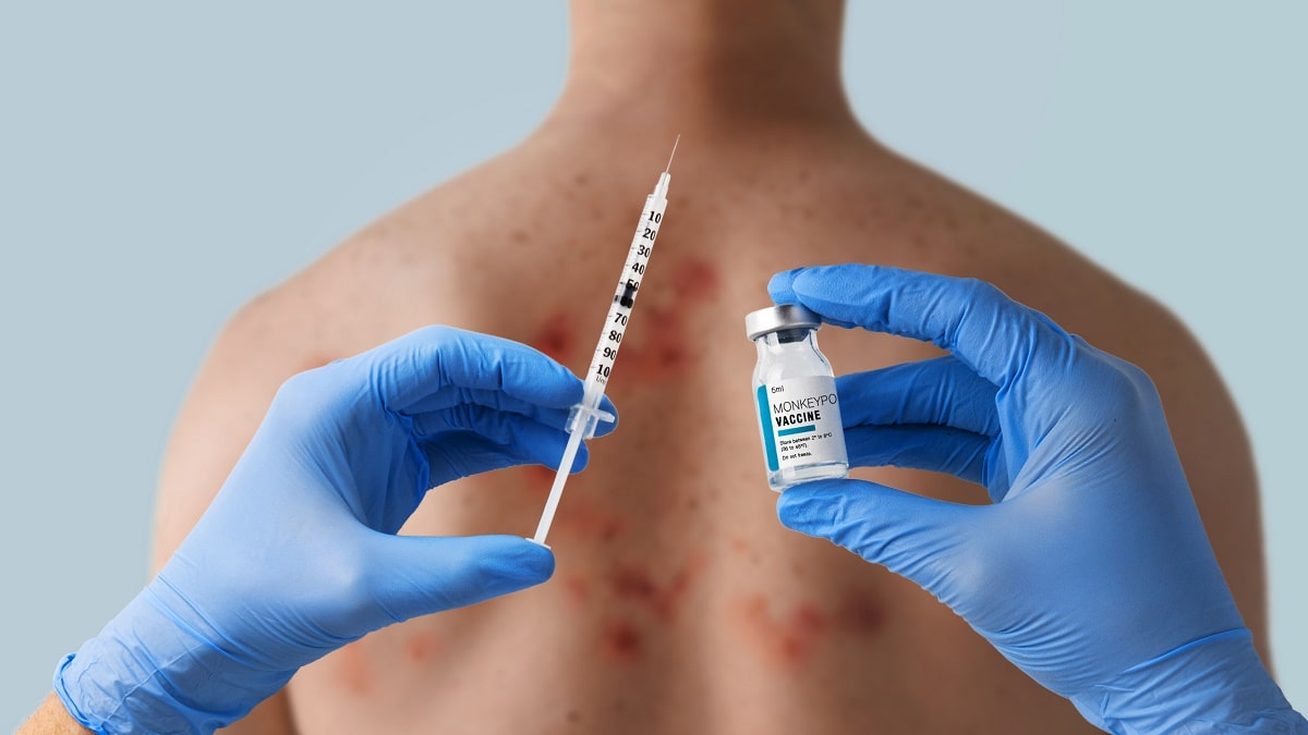 Transmission, prévention, symptômes : tout savoir sur la variole du singe